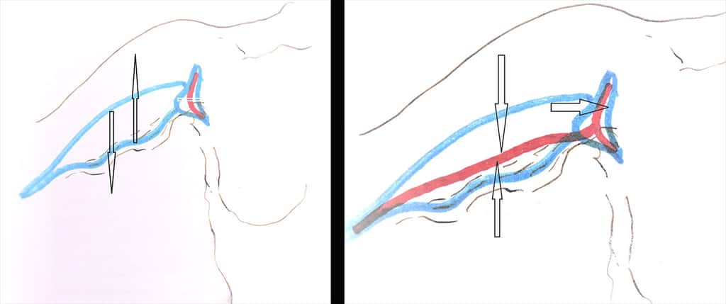 À gauche, dessin de la brachioplastie du bras en T et, à droite, cicatrice finale en T. © Dr Mitz, tous droits réservés