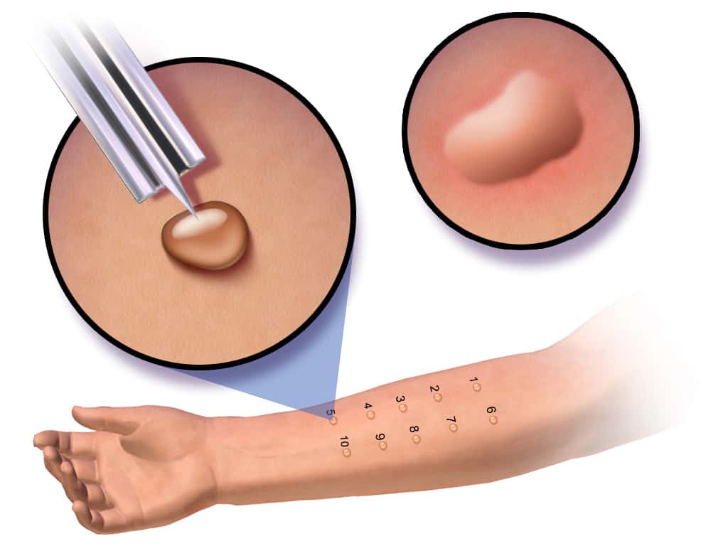 Le prick-test consiste à faire pénétrer une goutte d’allergène avec une seringue. Il est considéré comme positif si une papule de plus de 3 mm apparaît. © BruceBlaus, CC by-sa 4.0