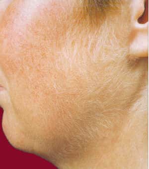 L'hirsutisme se manifeste par l'apparition de nombreux poils dans les zones caractéristiques de la pilosité masculine.