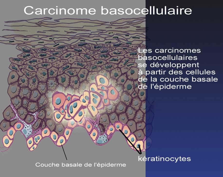 Le carcinome basocellulaire siège le plus souvent sur le visage et le dos. © DR