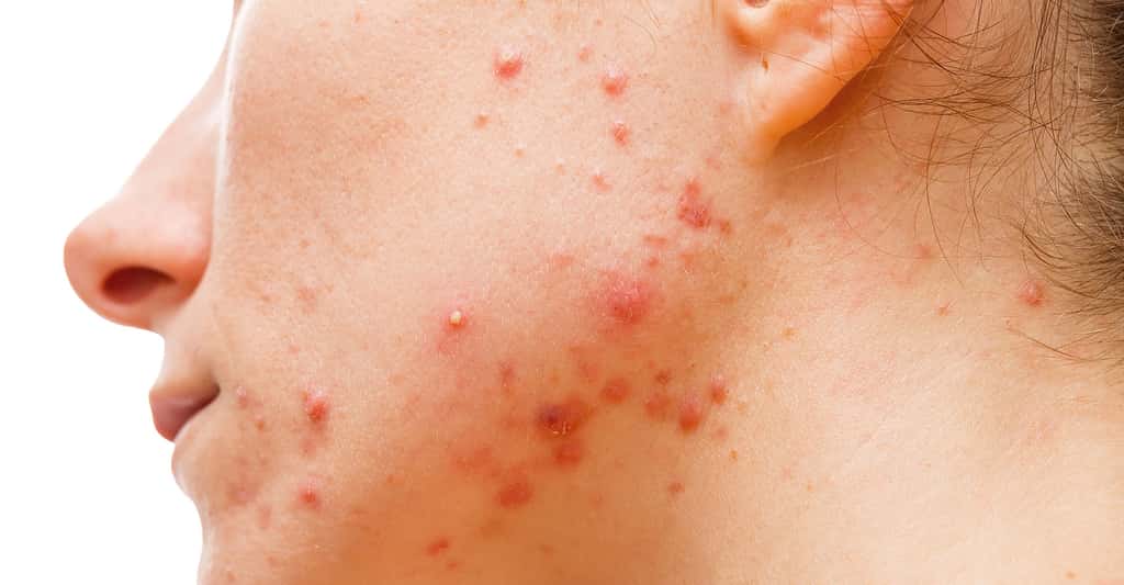 Quelques conseils à retenir sur les boutons d'acné. © Ocskay Bence , Shutterstock