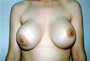 Contracture capsulaire du sein droit, sept ans après la pose d'un implant mammaire en silicone. © Walter Peters, <em>Wikimedia Commons, </em>domaine public