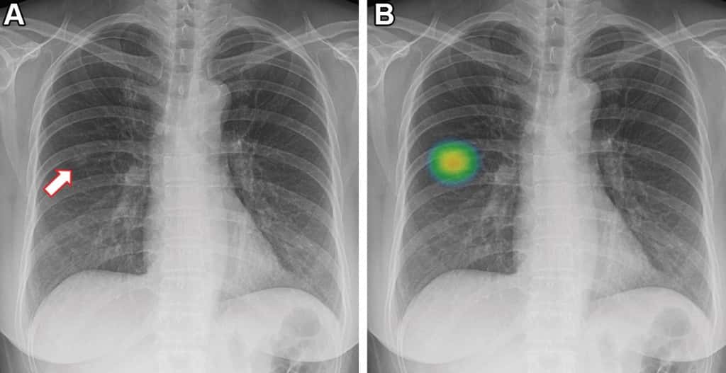 Images d'une femme de 60 ans qui a subi une radiographie pulmonaire à des fins de bilan de santé et qui a été affectée au groupe IA (intelligence artificielle). (A) La radiographie pulmonaire frontale montre une opacité nodulaire subtile (flèche) dans la zone pulmonaire moyenne droite. (B) La lésion a été détectée par le logiciel de détection assistée par ordinateur basé sur l'IA, avec une probabilité d'anomalie de 81,1 %. Le radiologue désigné a déclaré que cette radiographie pulmonaire était positive. © RADIOLOGICAL SOCIETY OF NORTH AMERICA
