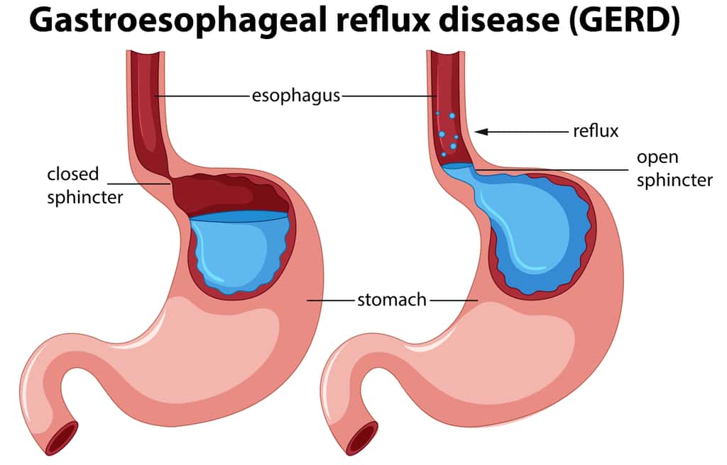 Reflux gastro-œsophagien : le contenu de l'estomac remonte par défaillance du muscle sphincter © brgfx, Freepick