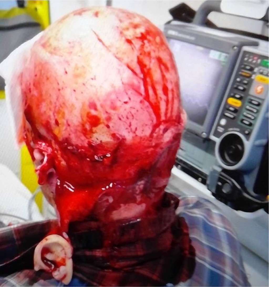 L'état de la patiente juste après son accident dans l'ambulance. Son cuir chevelu est totalement arraché ainsi que son oreille gauche. © Christoffer Bing Madsen et<em> al.,</em> <em>BMJ Case Reports</em>