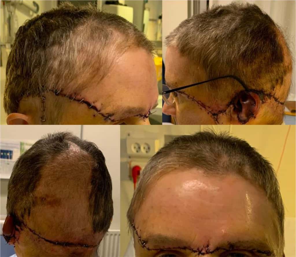 Le cuir chevelu de la patiente recousu sur son crâne. © Christoffer Bing Madsen et <em>al., BMJ Case Reports</em>