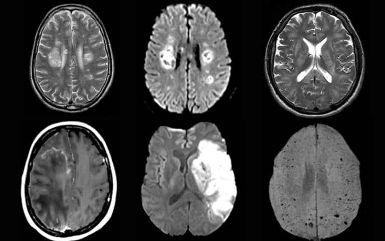 Scanner cérébral de trois patients de l'étude atteint de dommages cérébraux. © Paterson et al. <em>Brain</em> 2020