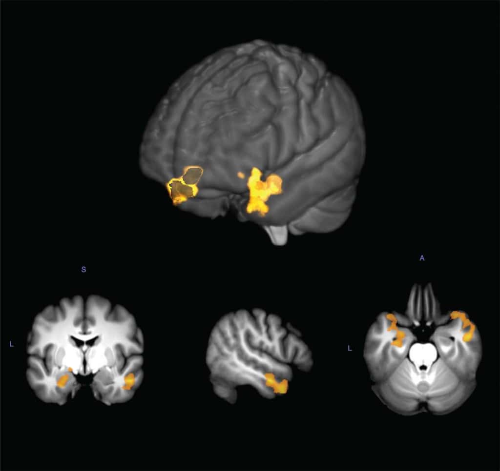 Les régions cérébrales activées par l'hexadécanal dans le cerveau des femmes et des hommes. © <em>Weizmann Institute of Science</em>