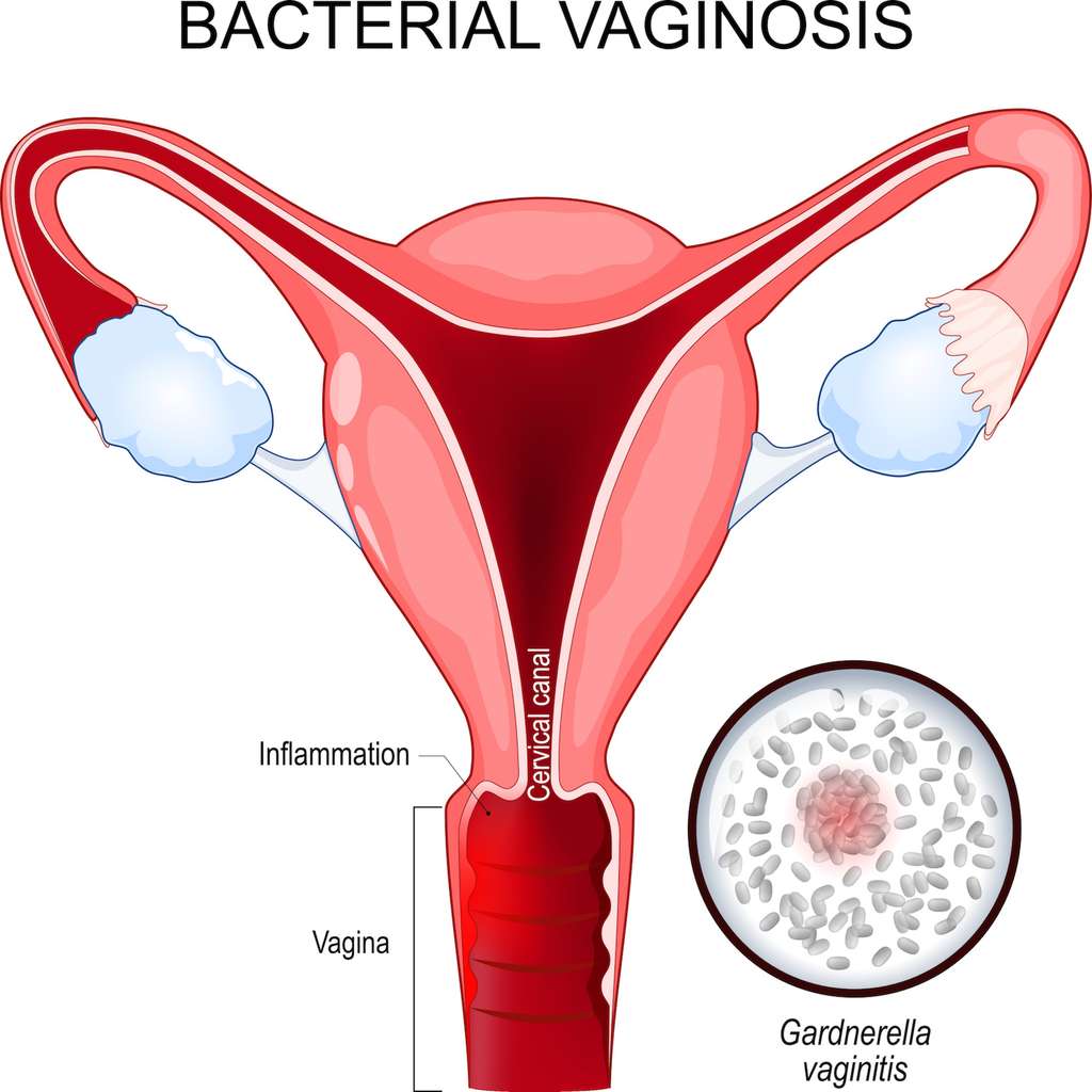 La vaginose bactérienne est une affection gynécologique courante qui peut entraîner inconfort et complications infectieuses, d’où l’importance d’étudier des pistes thérapeutiques sur des modèles comme la « puce cervicale ». © Designua, Adobe Stock 