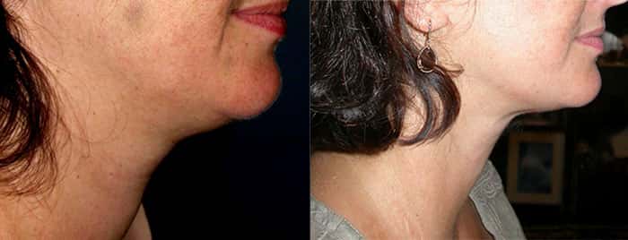 Lipolift du cou avant et après. © Dr Mitz, tous droits réservés