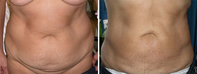 Liposuccion du ventre avant et après. © Dr Mitz, tous droits réservés