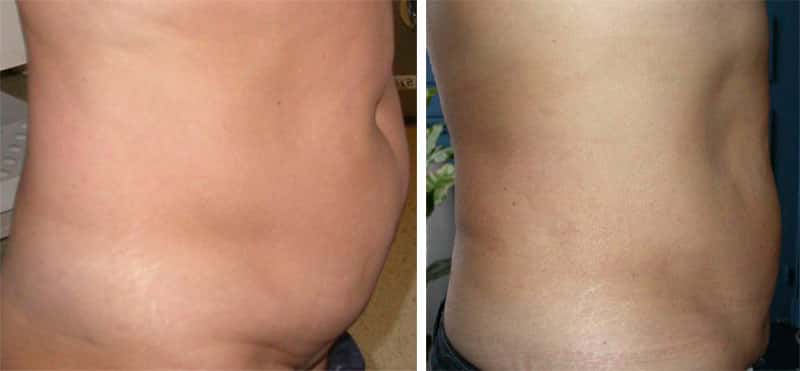 Autre liposuccion du ventre avant et après, vue de profil. © Dr Mitz, tous droits réservés