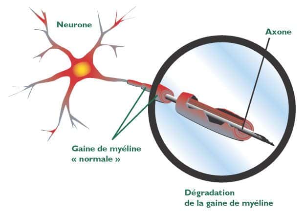 Chez les personnes souffrant de sclérose en plaques, la myéline entourant le nerf est détruite à certains endroits. L'influx nerveux est donc beaucoup moins bien transmis. © DR