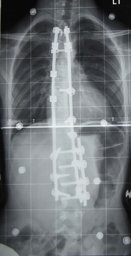 Radiographie d’une scoliose dorso-lombaire après opération. La courbe thoracique et la courbe lombaire ont été réduites. © Dr Junge, Wikipedia, DP