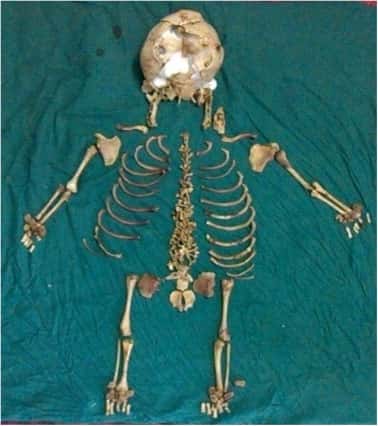 Le squelette du fœtus extrait du corps de la patiente de 60 ans. © B.S. Gedam, et al. <em>International Journal of Surgery Case Reports</em>