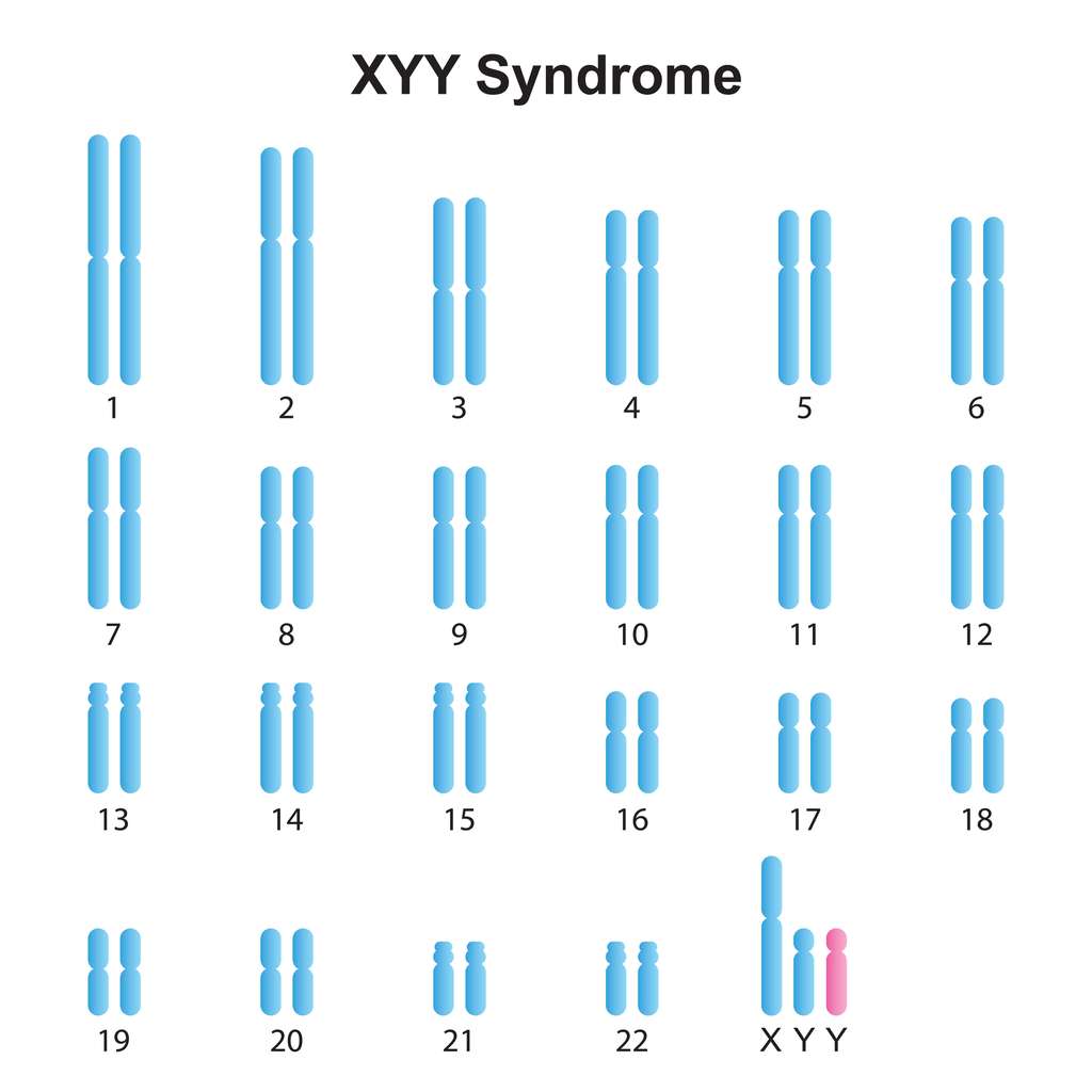 Dans le syndrome 47,XYY, aussi appelé syndrome de Jacob ou syndrome du double Y, la présence d’un chromosome Y apparaît en trop. © Ali, Adobe Stock