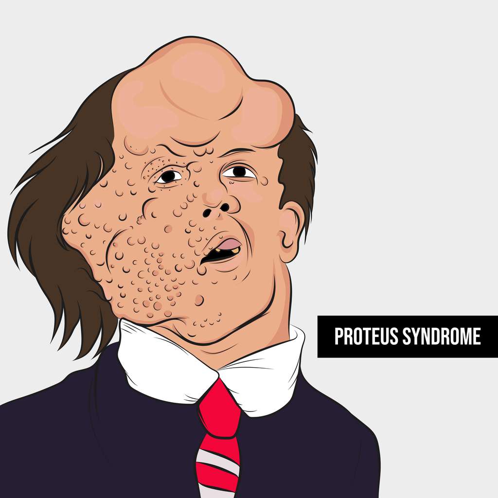 Illustration du syndrome de Protée, une maladie rare. © Michael Oscar, Adobe Stock