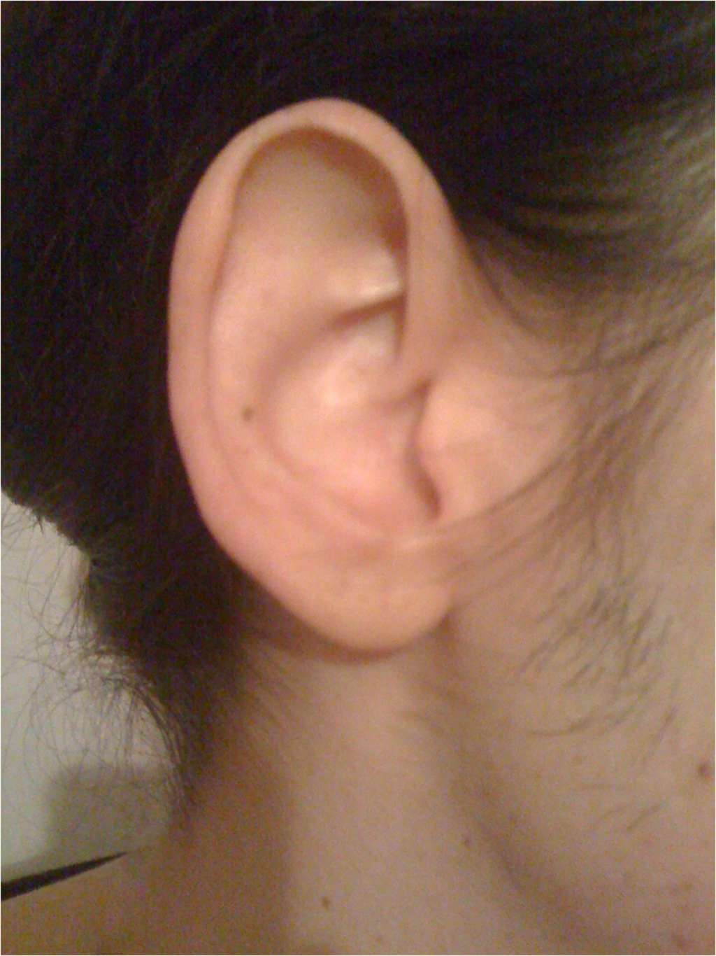 L'oreille de la patiente dans son état normal. © Chan, C.C. et Ghosh, J Med Case Reports 
