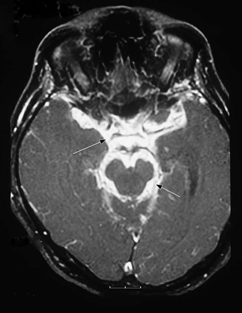 Imagerie par résonance magnétique (IRM) d'un patient atteint de méningite tuberculeuse montrant un exsudat inflammatoire intense à la base du cerveau (méninges basilaires – voir flèches) et entourant le tronc cérébral. © John E. Greenlee, MD