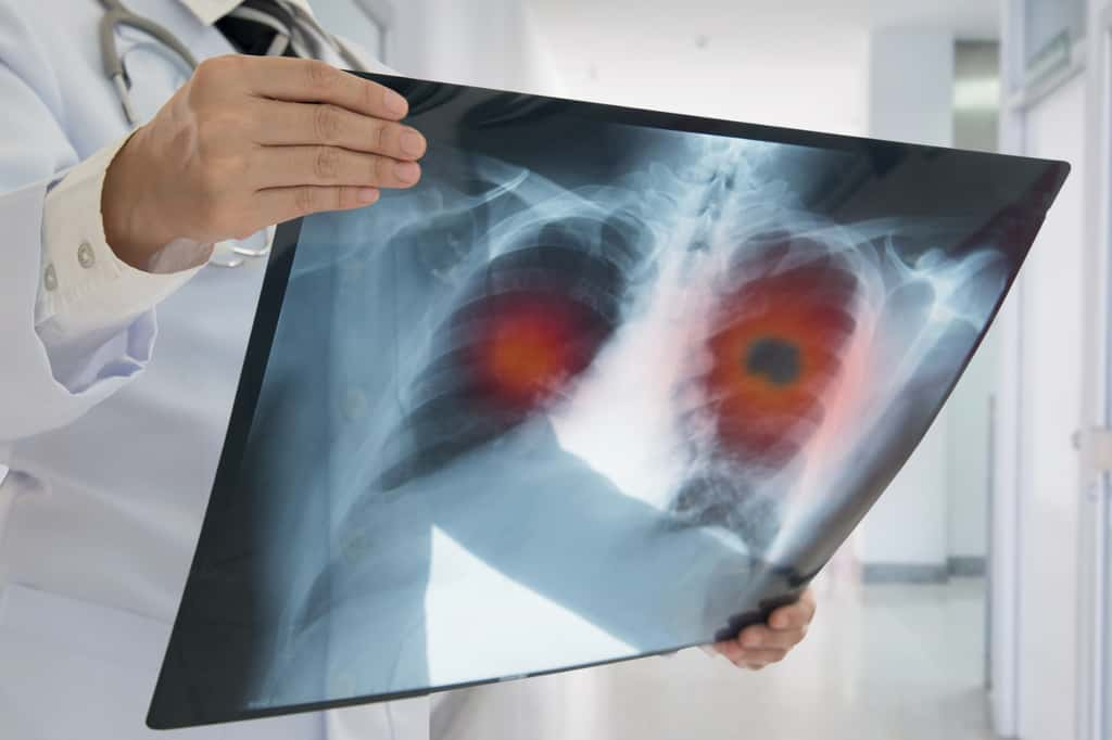 Entre l'apparition des premières tumeurs cancéreuses et le développement d'un cancer symptomatique, il peut s'écouler plusieurs années, voire une décennie. © Utah778, iStock