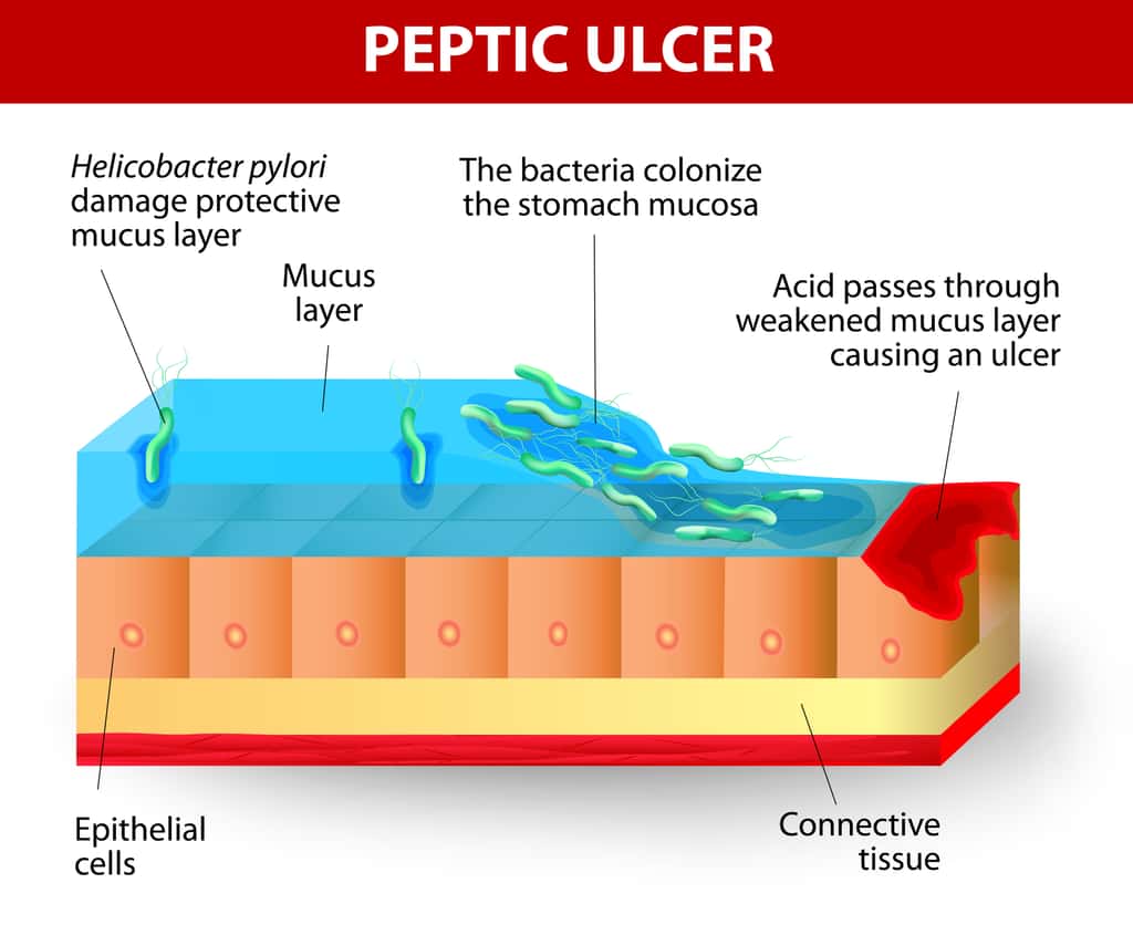  Ulcère gastrique provoqué par <em>Helicobacter pylori </em>: mécanisme d'action. © designua, adobe stock