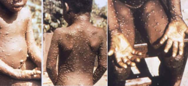 Éruption cutanée liée à la variole du singe chez un enfant. © CDC, <em>Wikipédia Commons</em>, Domaine Public