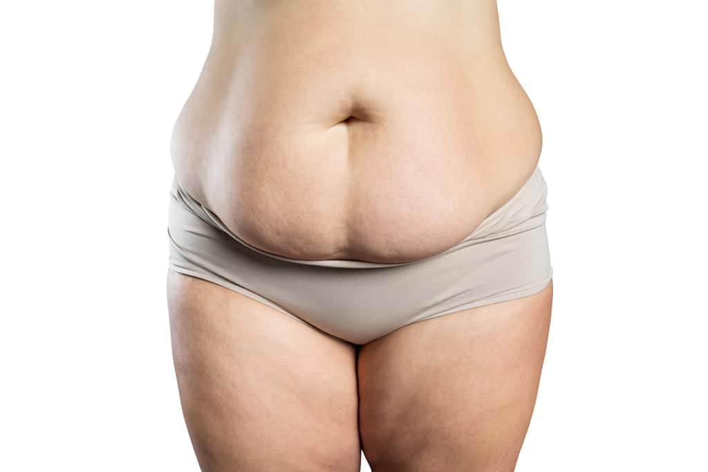  L'abdominoplastie est une intervention chirurgicale qui peut être indiquée à la suite d'une autre opération, d'une obésité ou encore d'une ou plusieurs grossesses. © staras, Adobe Stock