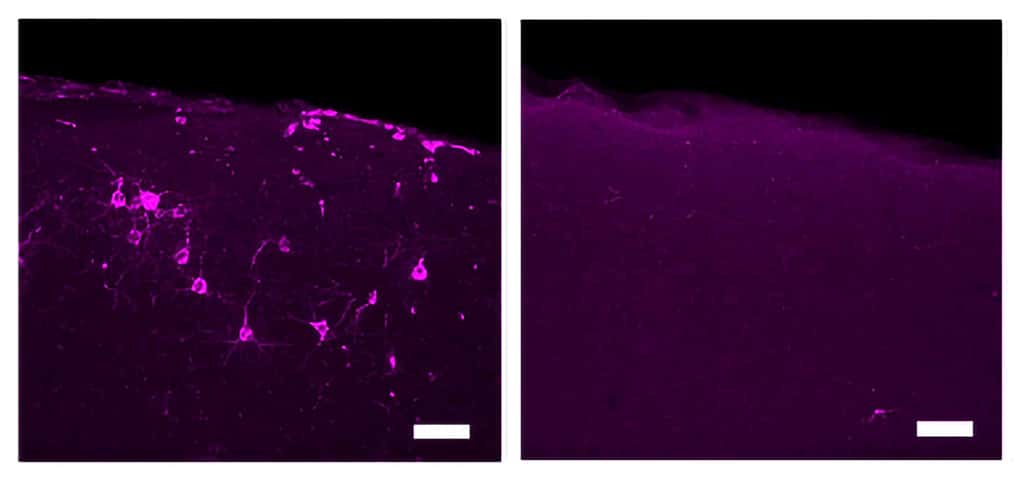L’image de droite met en évidence les réductions des protéines Tau phosphorylées (en magenta) dans les neurones corticaux somatosensoriels primaires chez les souris du modèle Tau P301S traitées avec une stimulation tactile de 40 Hz. L'image d'un témoin non traité se trouve à gauche. © Tsai Lab, MIT Picower Institute