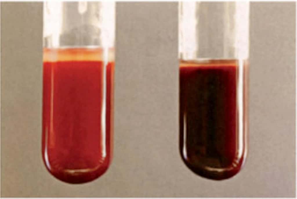 Comparaison entre de l'hémoglobine (à gauche) et de la méthémoglobine (à droite). © DeBaun, Vichinsky