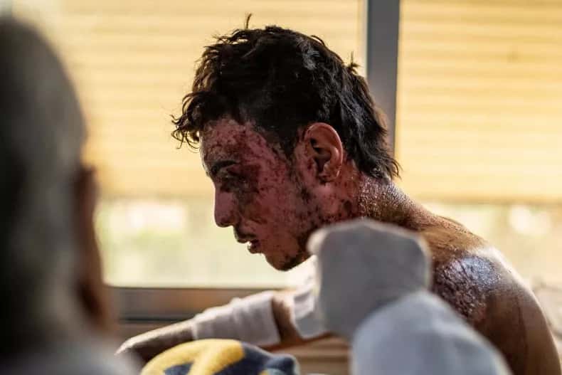 Un homme brûlé par une frappe de phosphore blanc sur la ville de Ras Al Hayn par la Turquie, en 2019. © Getty Images