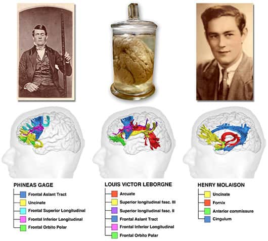 Les voies du cerveau endommagées dans les trois cas historiques étudiés. © M. Thiebaut de Schotten (avec l’autorisation d’<em>Oxford University Press</em>)