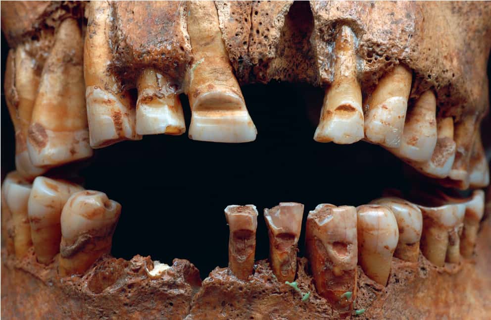Cent-trente squelettes d'individus vikings mâles ont été découverts avec des marques horizontales sur les dents. © SHM, Lisa Hartzell SHM 2007-06-13, CC by 2.5 SE