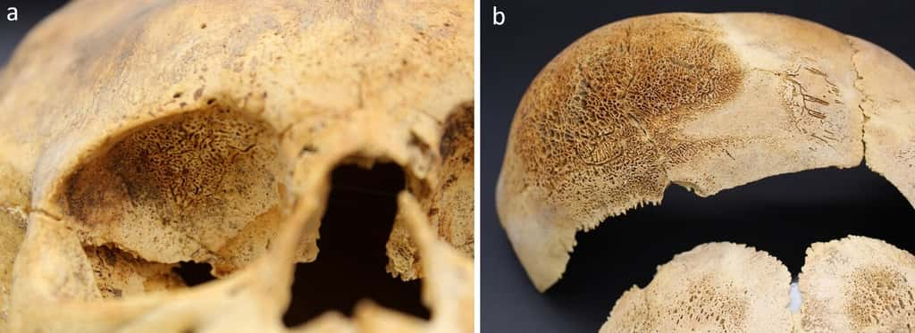 Les squelettes retrouvés dans un cimetière datant de 2 500 ans révèlent que les enfants étaient particulièrement touchés par de nombreuses maladies. © Pezo-Lanfranco et <em>al.</em> 2025