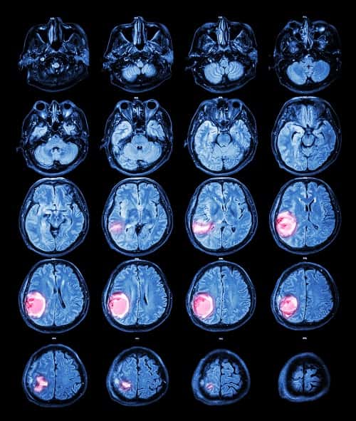 Les tumeurs cérébrales, ou plus généralement du système nerveux central, comprenant le cerveau et la moelle épinière, peuvent être bénignes ou cancéreuses et entraîner plus ou moins de séquelles, selon leur localisation et leur agressivité. Ici, une tumeur dans le lobe pariétal droit vue par IRM. © stockdevil, Fotolia