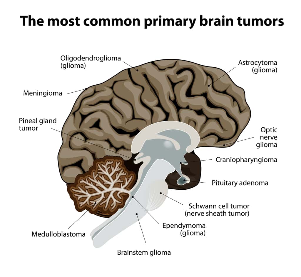 Schéma des tumeurs cérébrales primaires les plus courantes. © designua, Adobe Stock