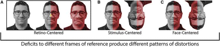 Les chercheurs répertorient trois types de distorsion visuelle : rétino-centré (A), où la distorsion dépend de la fixation, centré sur le stimulus (B) généralement du côté droit, et centré sur le visage (C), où la distorsion affecte les mêmes traits faciaux peu importe l'orientation de la tête. C'est de cette dernière forme dont semble souffrir le patient étudié. © Almeida et al. 2020, Current Biology