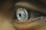 En clignant deux fois des yeux, le porteur des lentilles modifie la longueur focale, et ainsi active le zoom. © UC San Diego