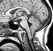 Le syndrome d’Arnold-Chiari est une malformation rare du cervelet. © Journal of Neurology, Neurosurgery, and Psychiatry