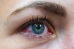 La conjonctivite allergique occasionne surtout des yeux rouges, associés à un sentiment d'irritation. © Munole, Adobe Stock