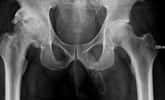Le pénis de ce patient est devenu aussi dur qu’un os. © Richard Assaker et al, Urology Case Reports, 2019