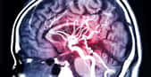 Une angiographie cérébrale est un examen radiologique qui permet d'identifier la cause d'une hémorragie méningée. ©&nbsp;samunella, Adobe Stock