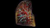 Les poumons d’un patient infecté par la Covid vus en tomographie à contraste de phase hiérarchique (HiP-CT). © UCL, ESRF