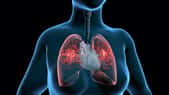La fibrose pulmonaire pourrait être&nbsp;responsable de troubles de la coagulation qui entraînerait des évènements thrombotiques mais des données rigoureuses manquent encore pour conclure définitivement.&nbsp;© TuMeggy, Adobe Stock