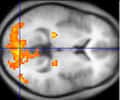 L’activation de la région du cerveau impliquée dans la perception visuelle, examinée par IRMF. Source Commons