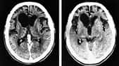 A droite, IRM d'un cerveau sain. A gauche, cerveau atteint de la maladie d'Alzheimer. Crédit NASA.