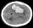 Les accidents vasculaires cérébraux (AVC) sont de deux types. Les plus fréquents se produisent lorsqu'un vaisseau du cerveau se bouche, et sont dits ischémiques. Les autres apparaissent quand un vaisseau se perfore et que le sang s'écoule dans le cerveau (comme le révèle la tache blanche sur l'image) : c'est l'hémorragie. La vitamine B pourrait aider à nous préserver de ce mal, qui touche plus de 100.000 Français chaque année. © James Heilman, Wikipédia, cc by sa 3.0