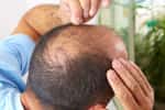 Celles et ceux qui vivent mal la perte de leurs cheveux vont peut-être retrouver un peu d’espoir grâce à des travaux de chercheurs britanniques. Ceux-ci proposent de traiter la calvitie à l’aide de médicaments anti-ostéoporoses. © Petrik, Fotolia
