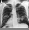 Le cancer des poumons est causé dans la majorité des cas par le tabac et se trouve être le cancer le plus mortel. Il est donc indispensable de le prendre en charge plus tôt pour mieux le guérir. Cette radiographie de la cage thoracique laisse entrevoir une grosseur (taches claires) qui est probablement une tumeur. © National Institute of Cancer/Wikipédia, DP