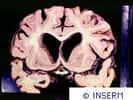 Crédits : Maladie d'alzheimer. Coupe de cerveau humain, atrophie corticale et dilatation ventriculaire.