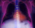 Crédits : INSERM ALPHA PICT 2000Radiographie du thorax après pontage coronaire. On distingue les fils de suture en acier au niveau du sternum.